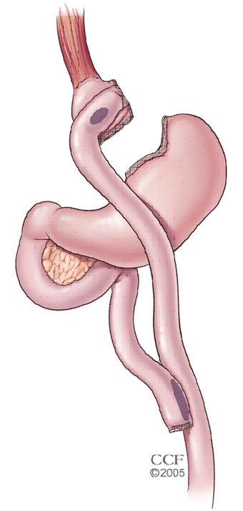 Diagram of gastric bypass sugery
