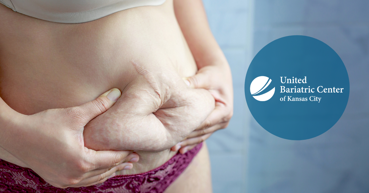 Woman gripping her belly fat
