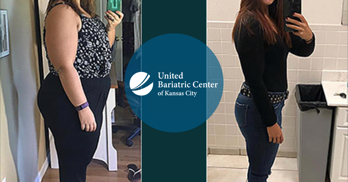 Woman's before and after bariatric surgery weight loss photos