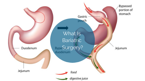 Gastric Sleeve Surgery for Weight Loss, Bariatric Services