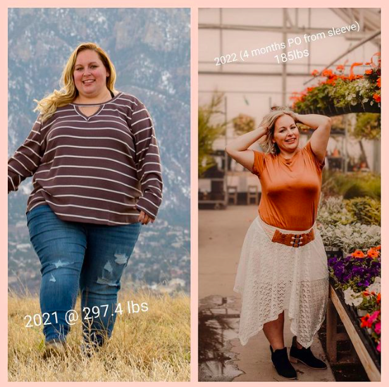 Gastric Sleeve - Top 10 Reasons Why People Get It in 2023 - United